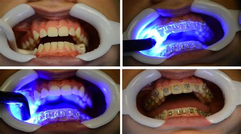 failed braces result|Orthodontic bracket bonding techniques and adhesion failures: A .